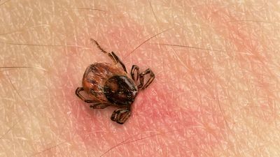 Zecke, die in die Haut gestochen hat